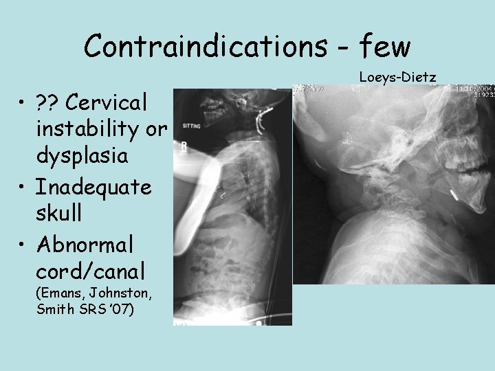 Contraindications - few • ? ? Cervical instability or dysplasia • Inadequate skull •