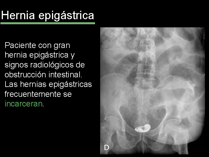Hernia epigástrica Paciente con gran hernia epigástrica y signos radiológicos de obstrucción intestinal. Las