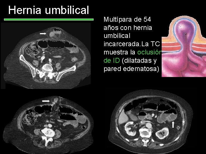 Hernia umbilical Multípara de 54 años con hernia umbilical incarcerada. La TC muestra la