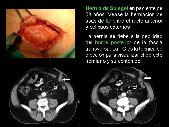 Hernia de Spiegel en paciente de 58 años. Véase la herniación de asas de