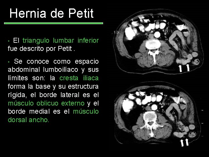 Hernia de Petit El triangulo lumbar inferior fue descrito por Petit. • Se conoce