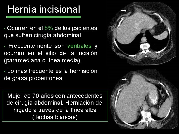 Hernia incisional Ocurren en el 5% de los pacientes que sufren cirugía abdominal •
