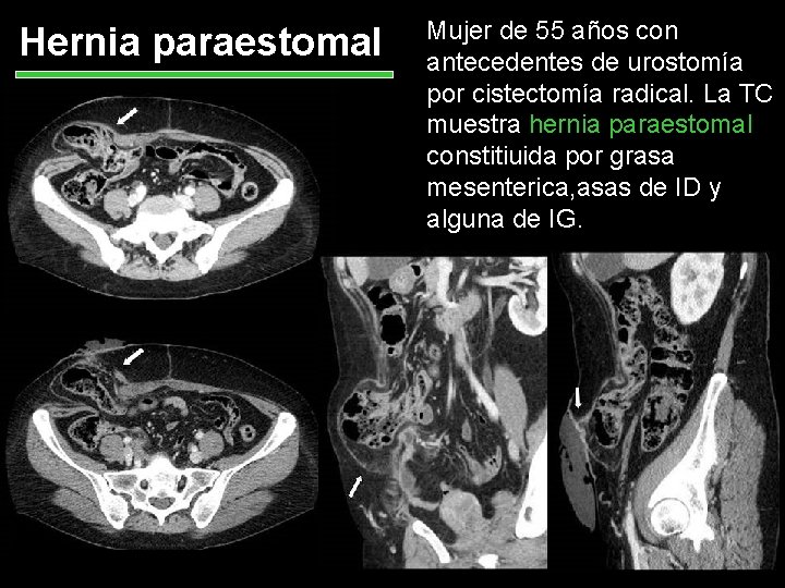 Hernia paraestomal Mujer de 55 años con antecedentes de urostomía por cistectomía radical. La