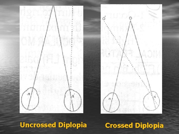 Uncrossed Diplopia Crossed Diplopia 