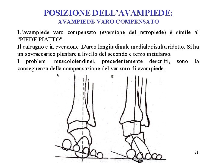 POSIZIONE DELL’AVAMPIEDE: AVAMPIEDE VARO COMPENSATO L’avampiede varo compensato (eversione del retropiede) è simile al