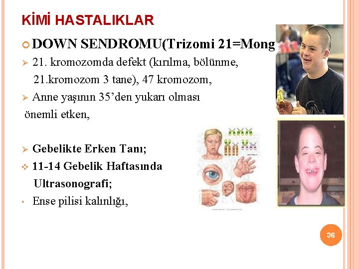 KİMİ HASTALIKLAR DOWN SENDROMU(Trizomi 21=Mongolizm); 21. kromozomda defekt (kırılma, bölünme, 21. kromozom 3 tane),