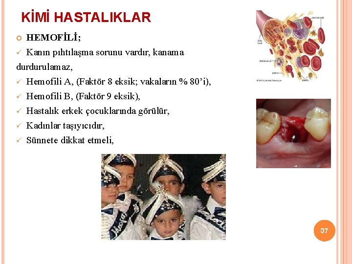 KİMİ HASTALIKLAR HEMOFİLİ; ü Kanın pıhtılaşma sorunu vardır, kanama durdurulamaz, ü Hemofili A, (Faktör