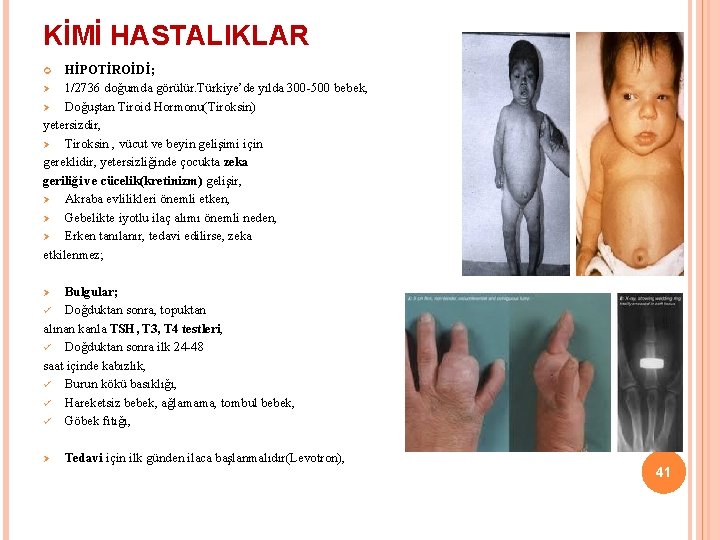 KİMİ HASTALIKLAR HİPOTİROİDİ; Ø 1/2736 doğumda görülür. Türkiye’de yılda 300 -500 bebek, Ø Doğuştan