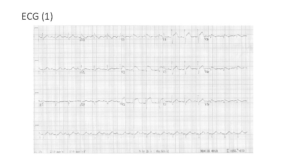 ECG (1) 