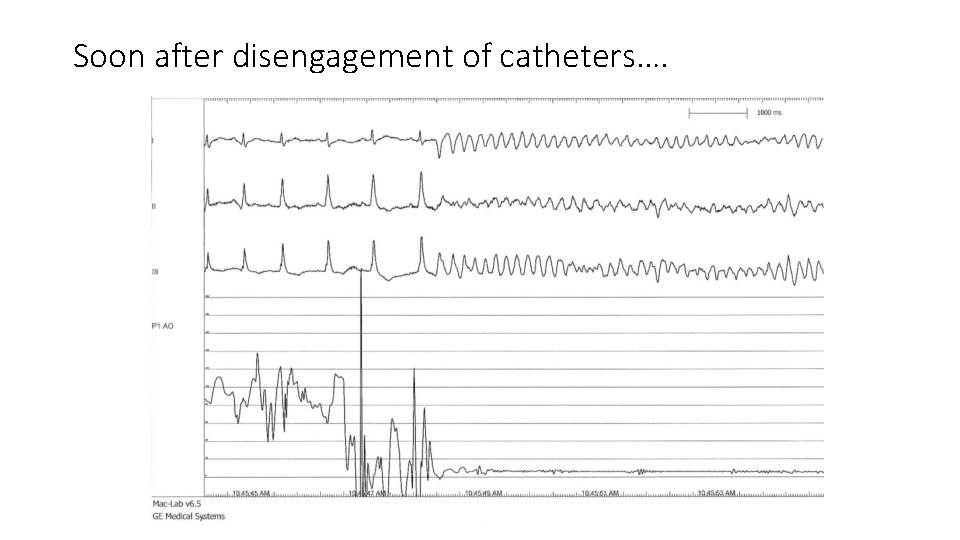 Soon after disengagement of catheters…. 