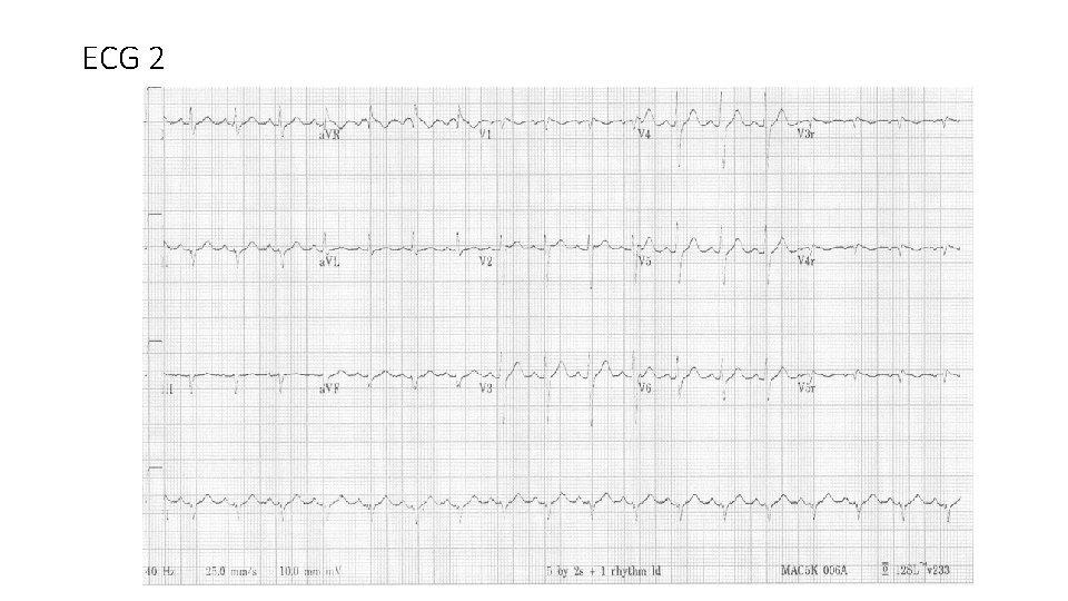 ECG 2 