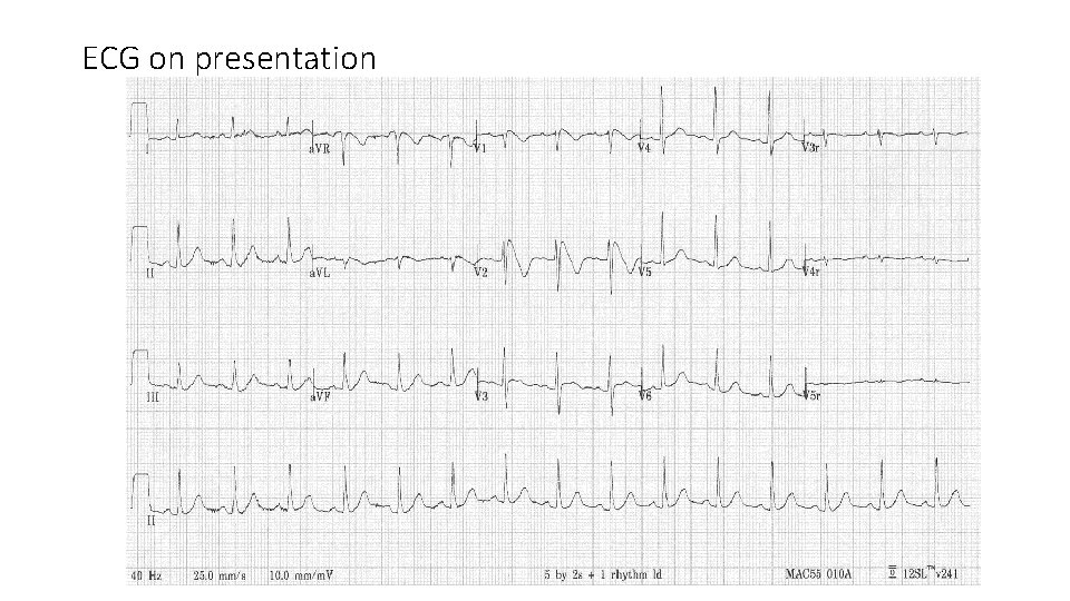 ECG on presentation 