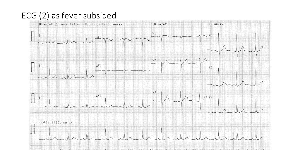 ECG (2) as fever subsided 