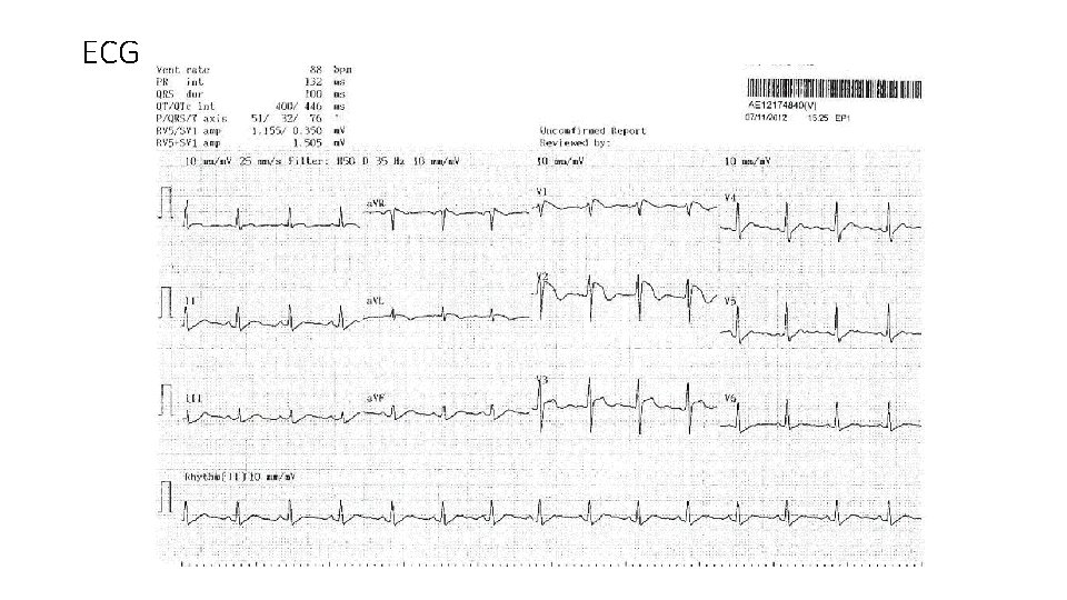 ECG 