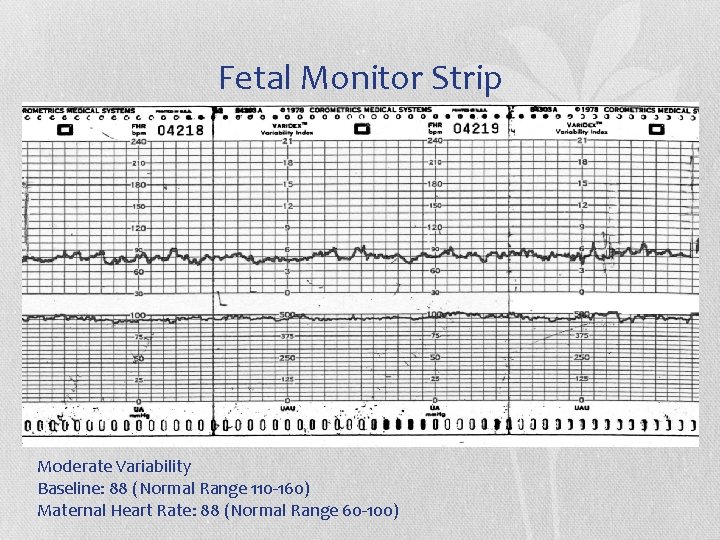 Fetal Monitor Strip Moderate Variability Baseline: 88 (Normal Range 110 -160) Maternal Heart Rate: