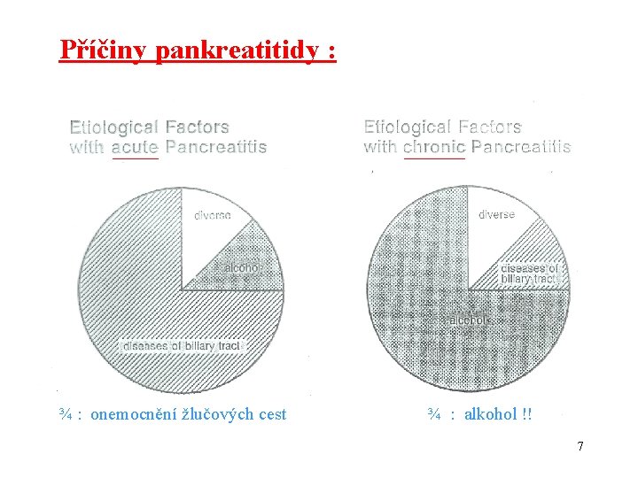 Příčiny pankreatitidy : ¾ : onemocnění žlučových cest ¾ : alkohol !! 7 