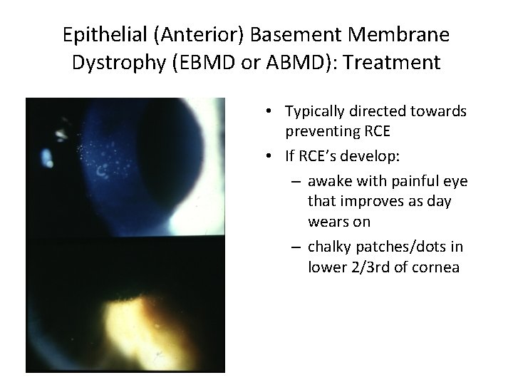 Epithelial (Anterior) Basement Membrane Dystrophy (EBMD or ABMD): Treatment • Typically directed towards preventing