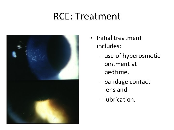 RCE: Treatment • Initial treatment includes: – use of hyperosmotic ointment at bedtime, –