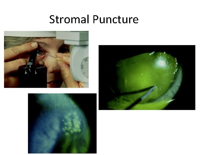 Stromal Puncture 
