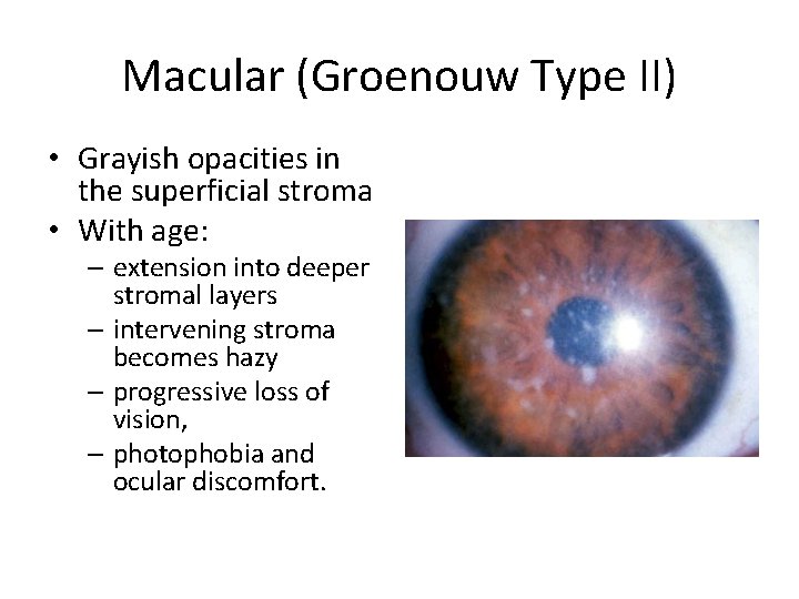 Macular (Groenouw Type II) • Grayish opacities in the superficial stroma • With age: