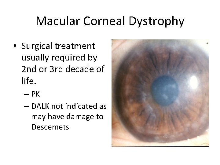 Macular Corneal Dystrophy • Surgical treatment usually required by 2 nd or 3 rd