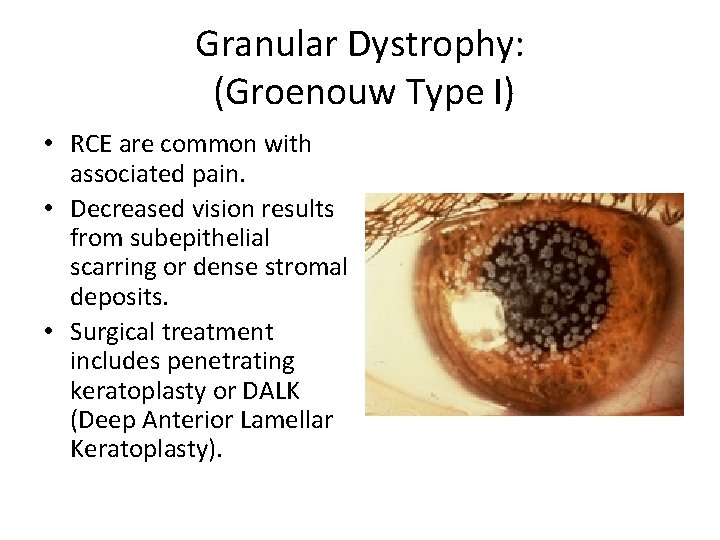 Granular Dystrophy: (Groenouw Type I) • RCE are common with associated pain. • Decreased