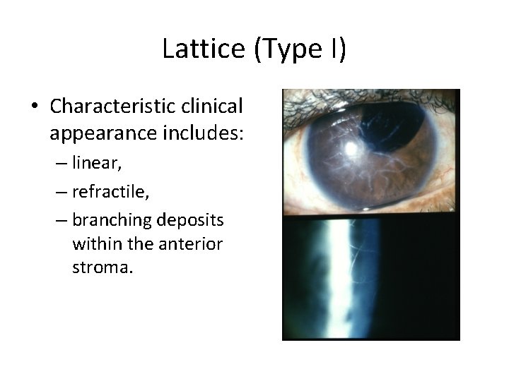 Lattice (Type I) • Characteristic clinical appearance includes: – linear, – refractile, – branching