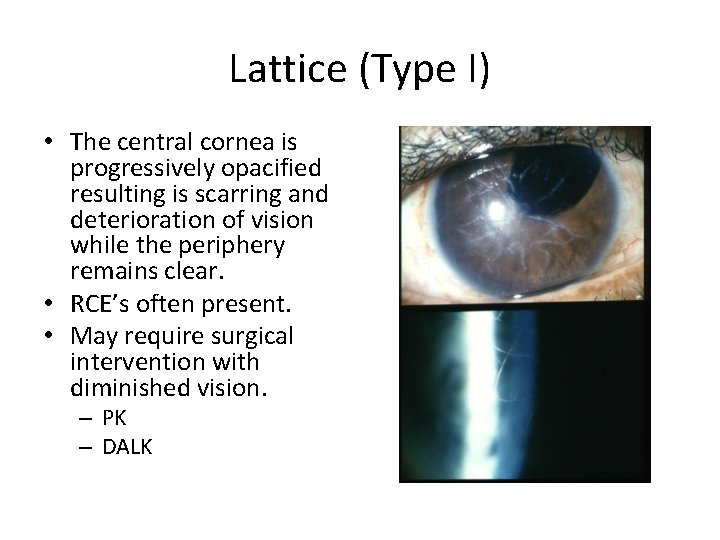Lattice (Type I) • The central cornea is progressively opacified resulting is scarring and