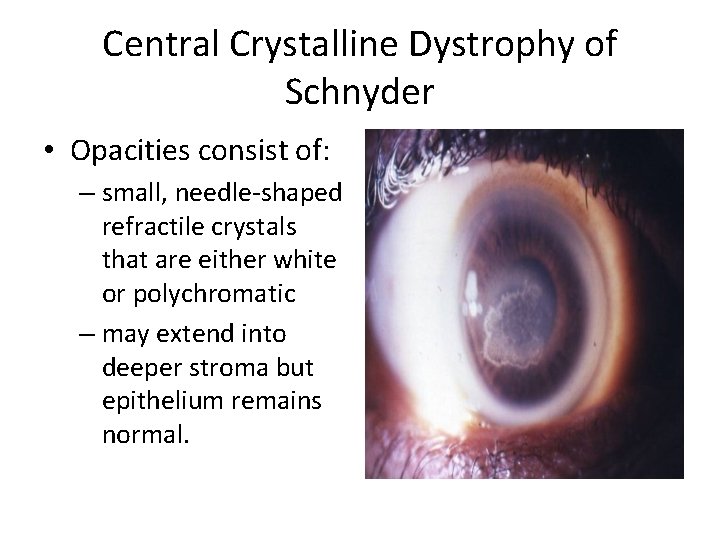 Central Crystalline Dystrophy of Schnyder • Opacities consist of: – small, needle-shaped refractile crystals