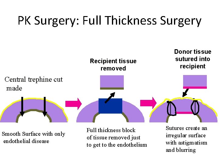 PK Surgery: Full Thickness Surgery Recipient tissue removed Donor tissue sutured into recipient Central