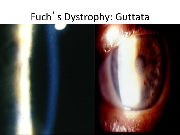 Fuch’s Dystrophy: Guttata 