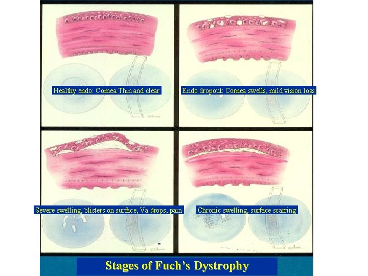 Healthy endo: Cornea Thin and clear Endo dropout: Cornea swells, mild vision loss Severe