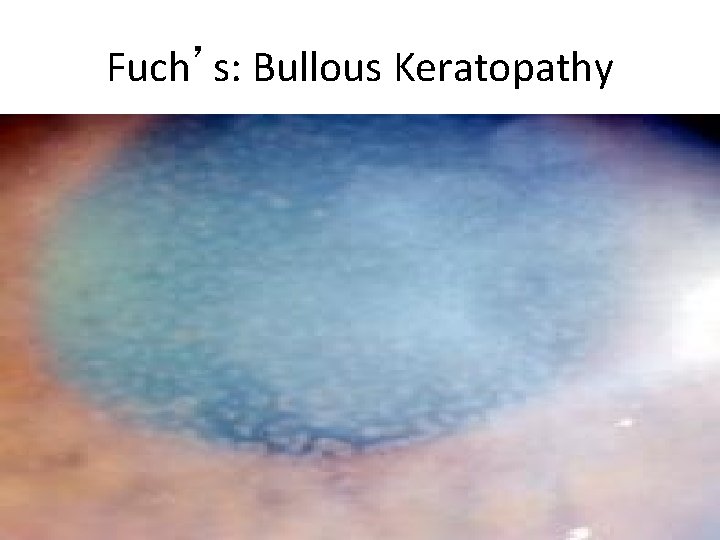 Fuch’s: Bullous Keratopathy 