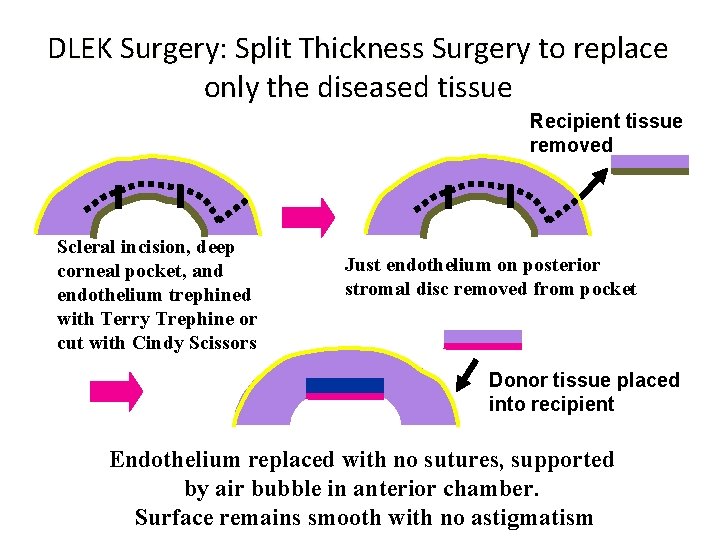 DLEK Surgery: Split Thickness Surgery to replace only the diseased tissue Recipient tissue removed