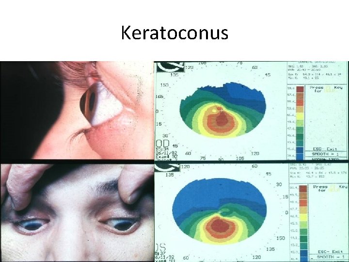 Keratoconus 