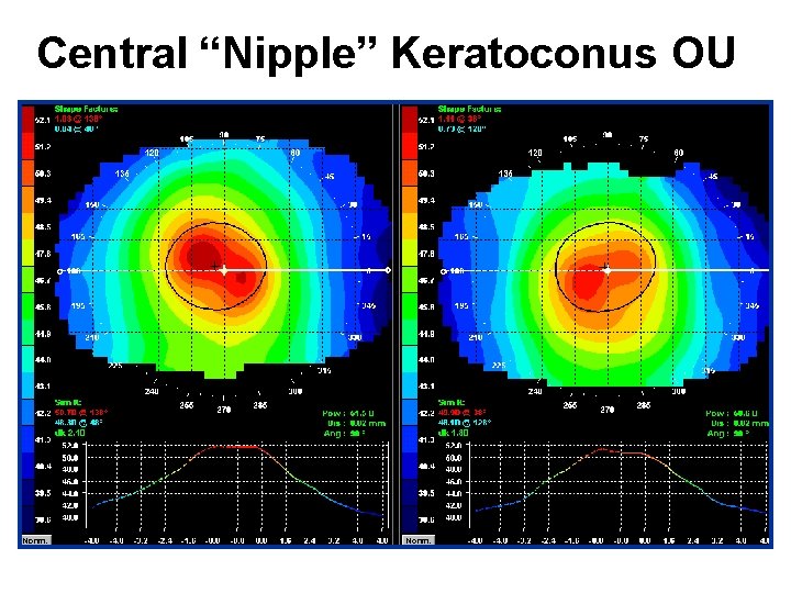 Central “Nipple” Keratoconus OU 