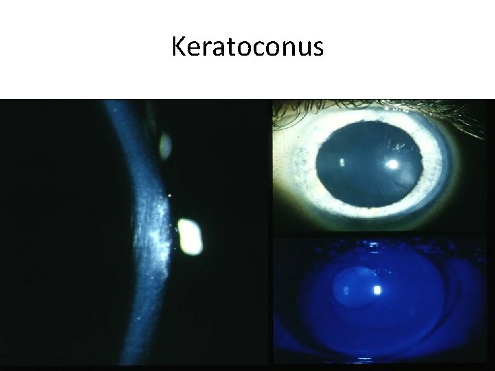 Keratoconus 