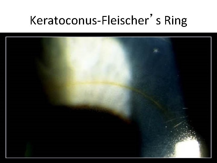 Keratoconus-Fleischer’s Ring 