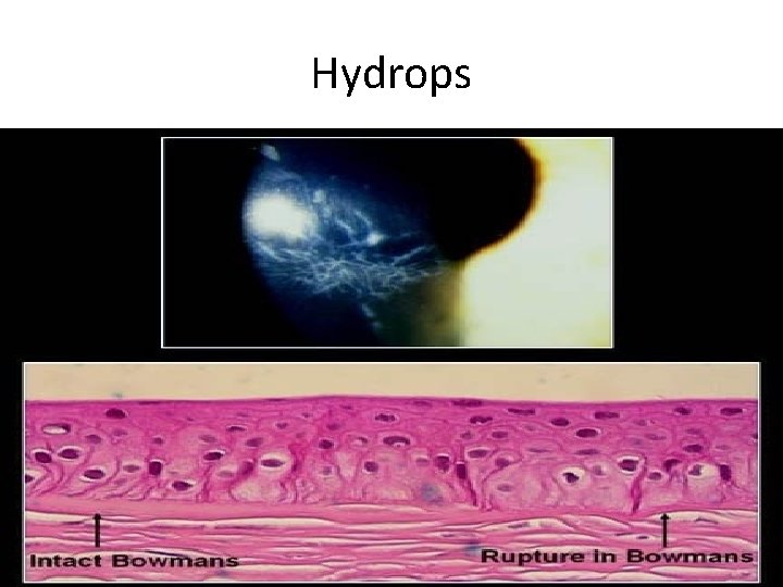 Hydrops 