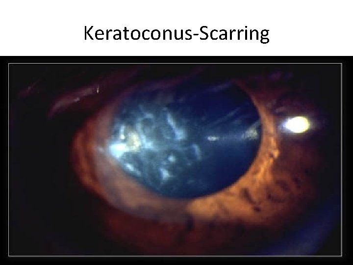 Keratoconus-Scarring 