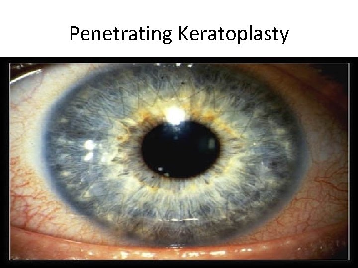 Penetrating Keratoplasty 