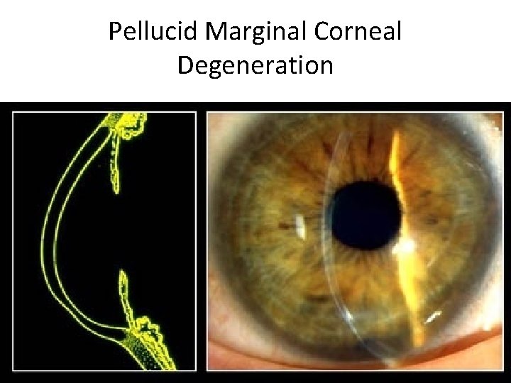 Pellucid Marginal Corneal Degeneration 