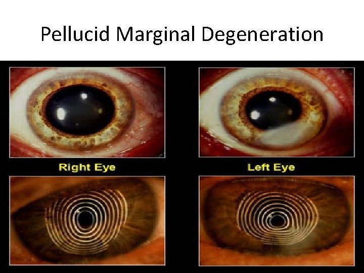 Pellucid Marginal Degeneration 