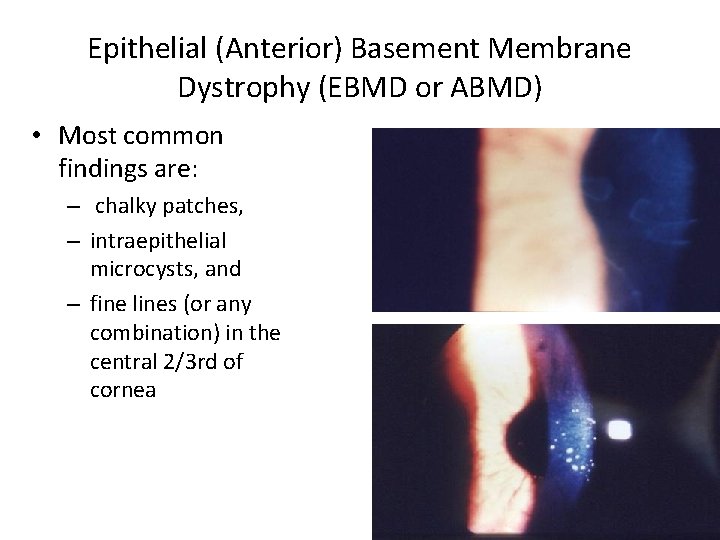 Epithelial (Anterior) Basement Membrane Dystrophy (EBMD or ABMD) • Most common findings are: –