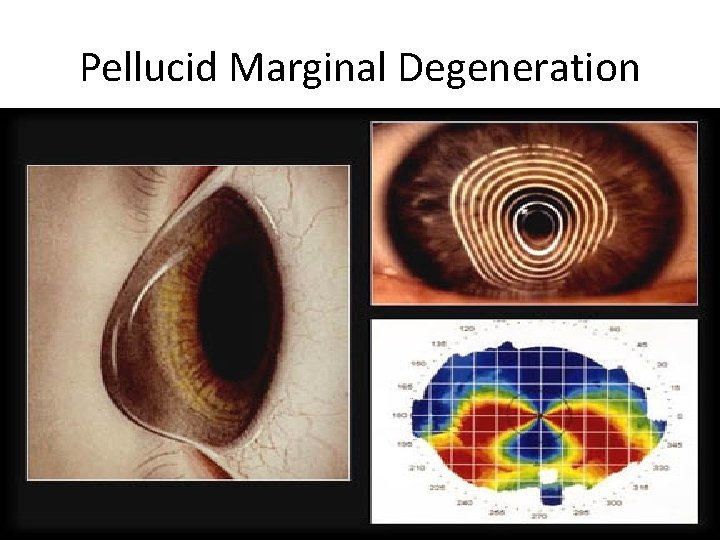 Pellucid Marginal Degeneration 