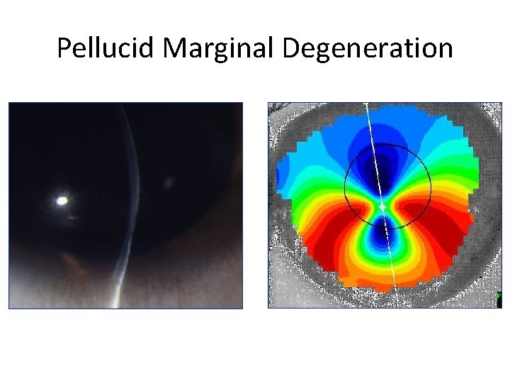 Pellucid Marginal Degeneration 