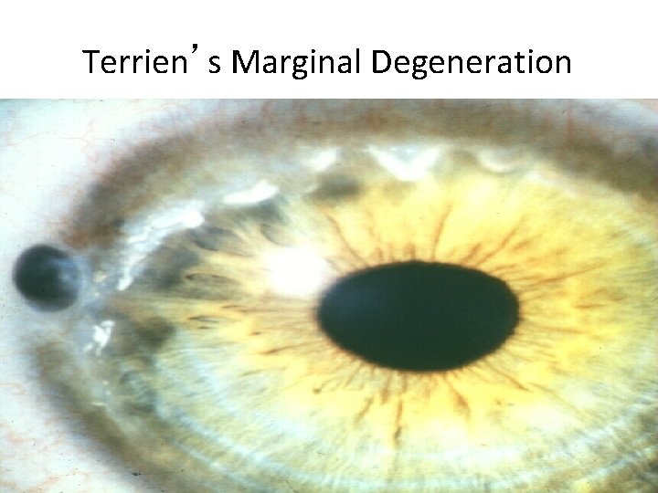 Terrien’s Marginal Degeneration 