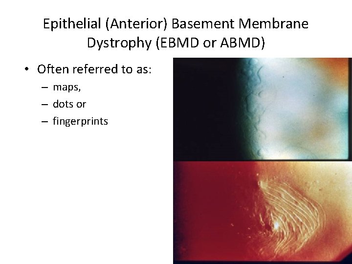 Epithelial (Anterior) Basement Membrane Dystrophy (EBMD or ABMD) • Often referred to as: –