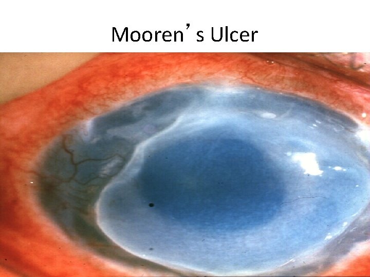 Mooren’s Ulcer 