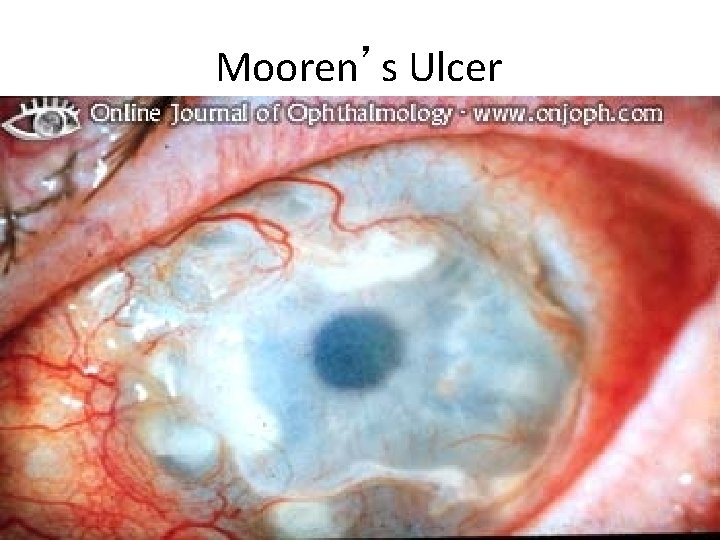 Mooren’s Ulcer 